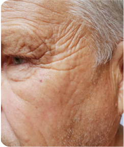 Anti-Wrinkle & Dermal Fillers