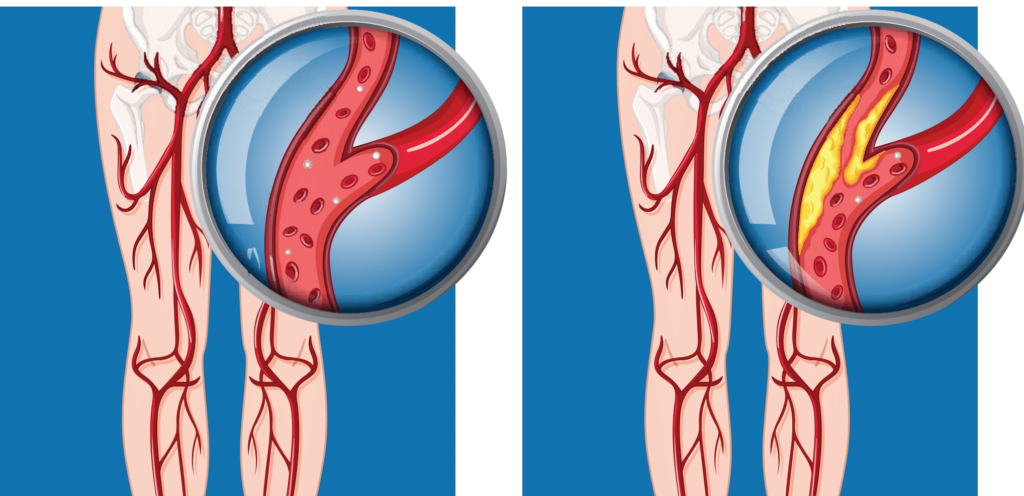peripheral artery disease leg pain